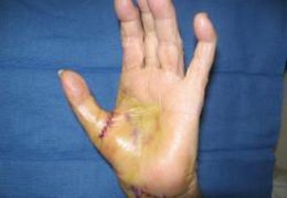 Arthritis of the Hand