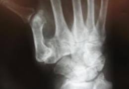 Arthritis of the Hand