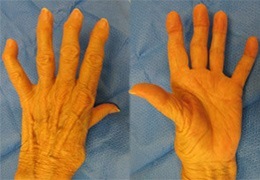 Arthritis of the Hand